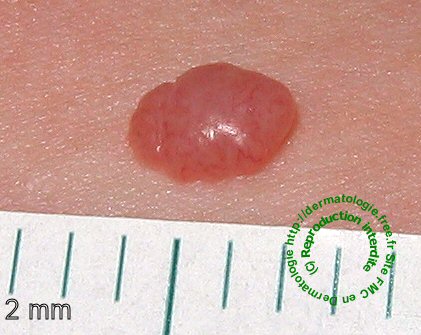 Pink Melanoma image