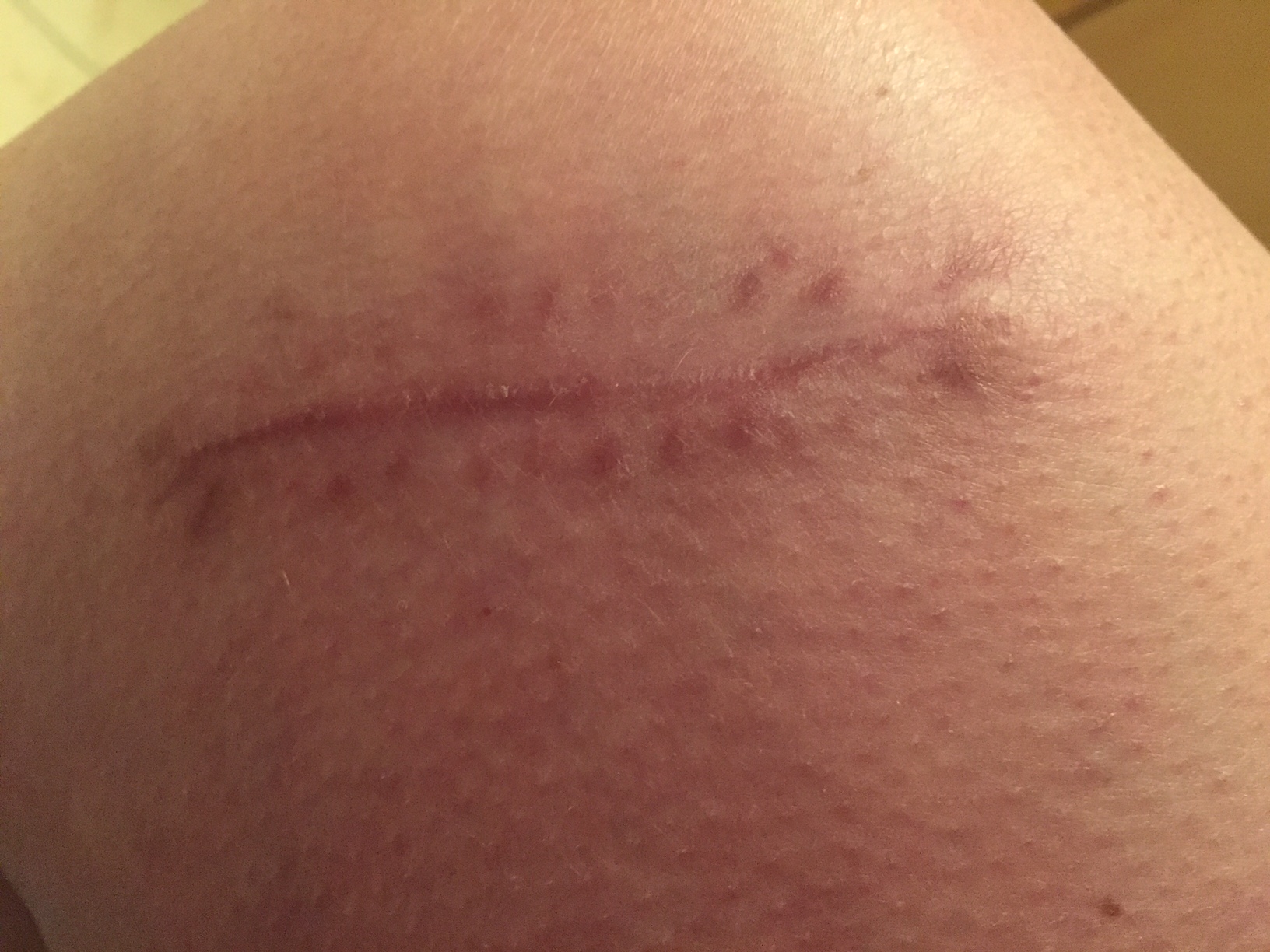 The scar at 10 weeks