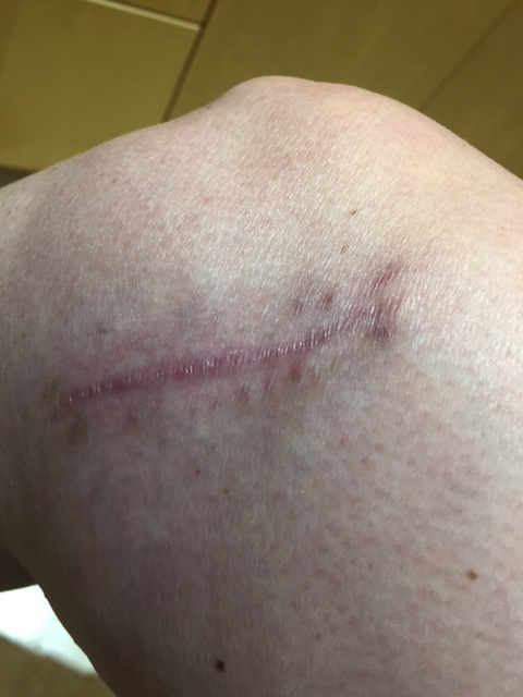 4 month scar